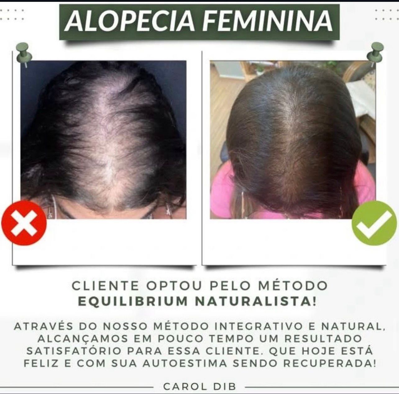 Antes e depois do tratamento capilar naturalista - Caso 1
