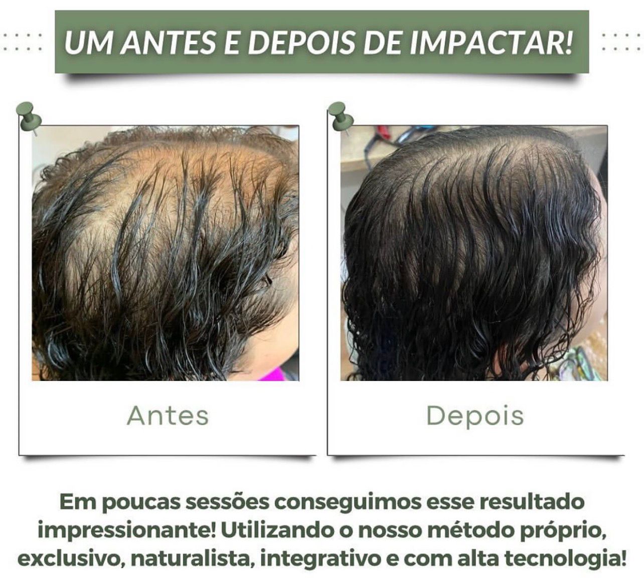 Antes e depois do tratamento capilar naturalista - Caso 2